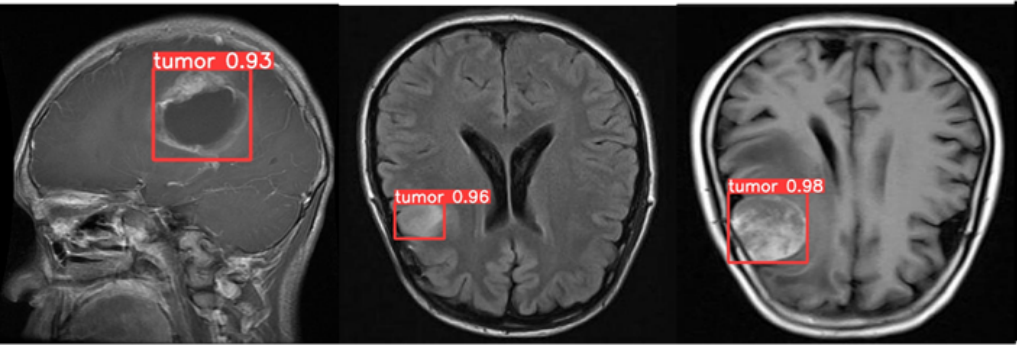 Tumor detection visual example